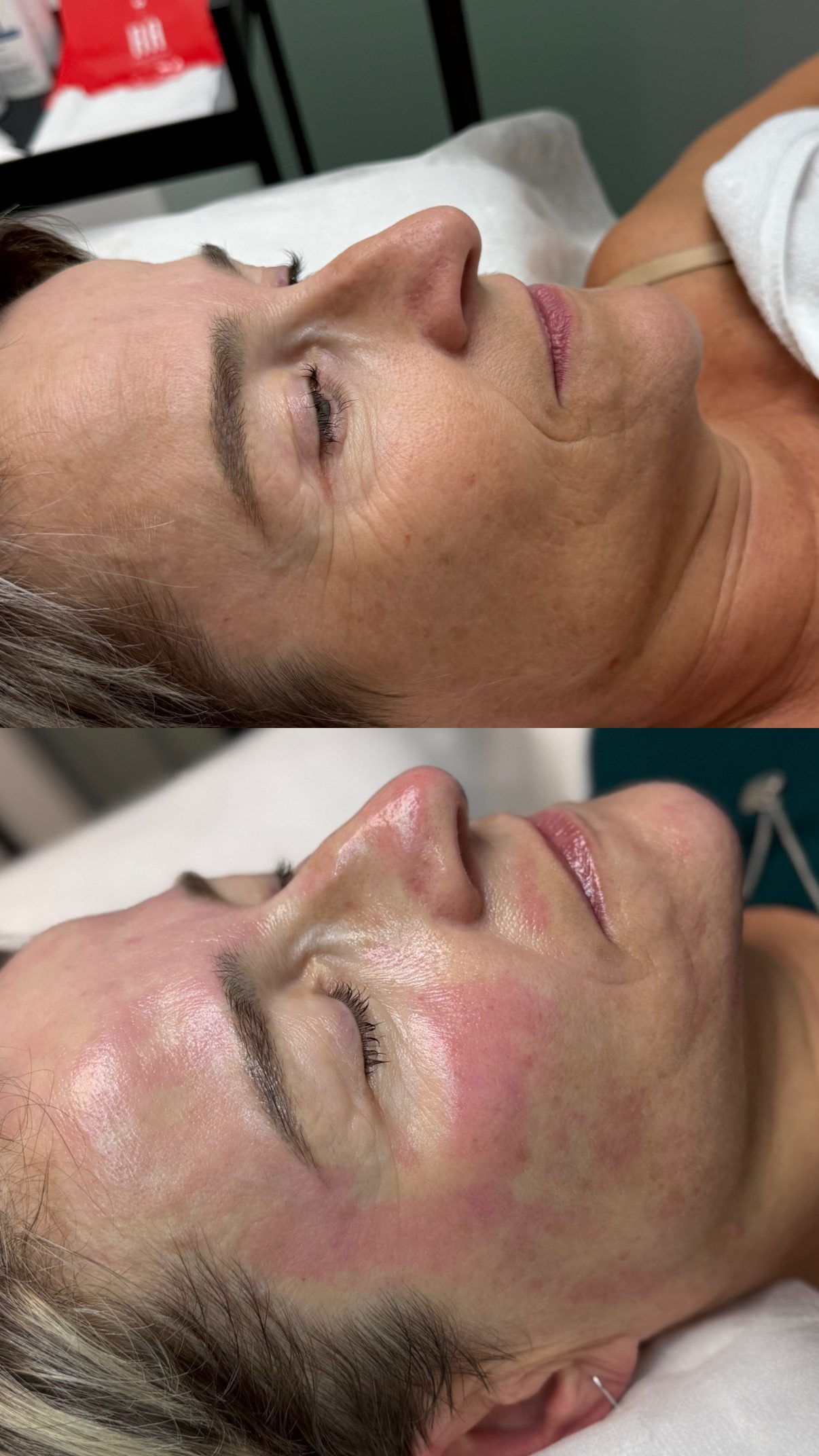 Nanoderm – omlazení pleti