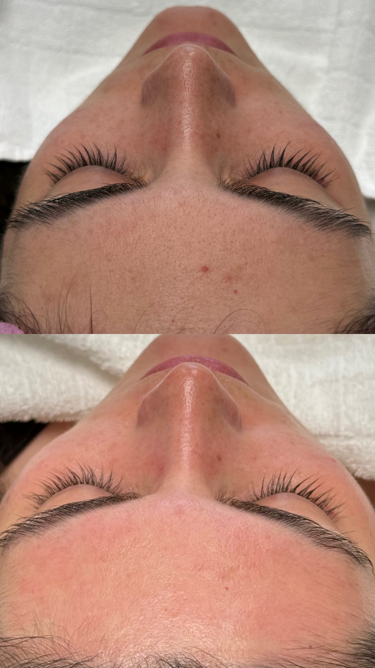 Dermapen
